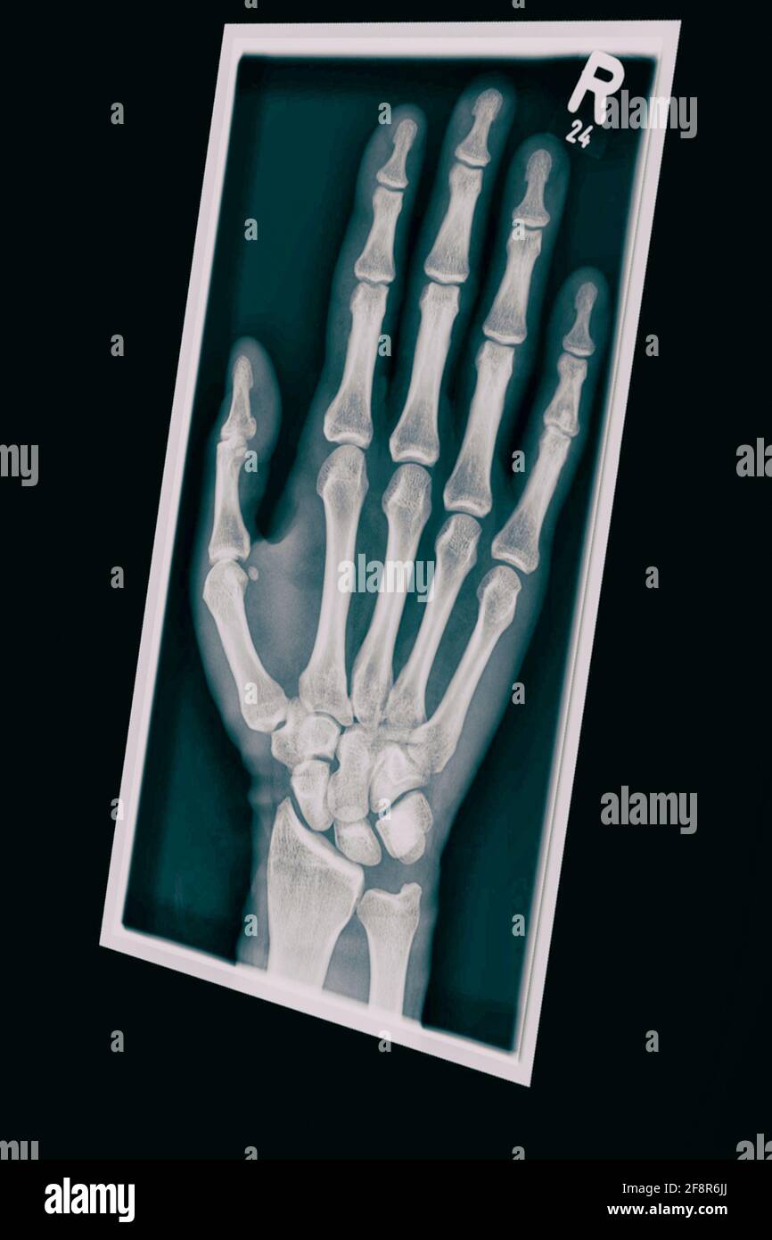 3d rendering of a human hand x-ray photo Stock Photo - Alamy