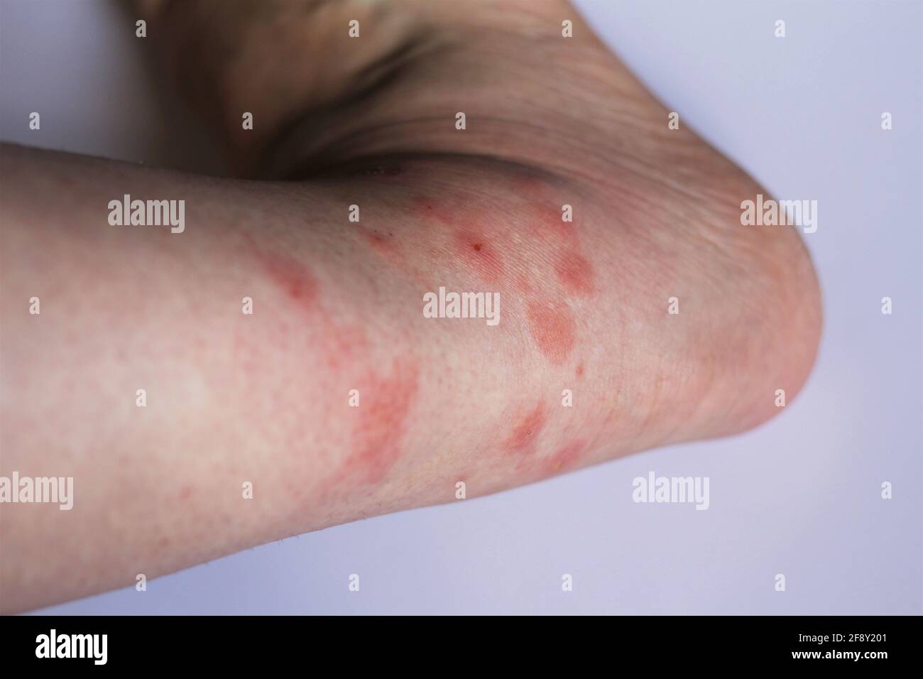 Selective focus on ankle. Woman's leg with multiple mosquito bites which has cause inflammation in her skin around the swollen ankle. Allergic reaction Stock Photo