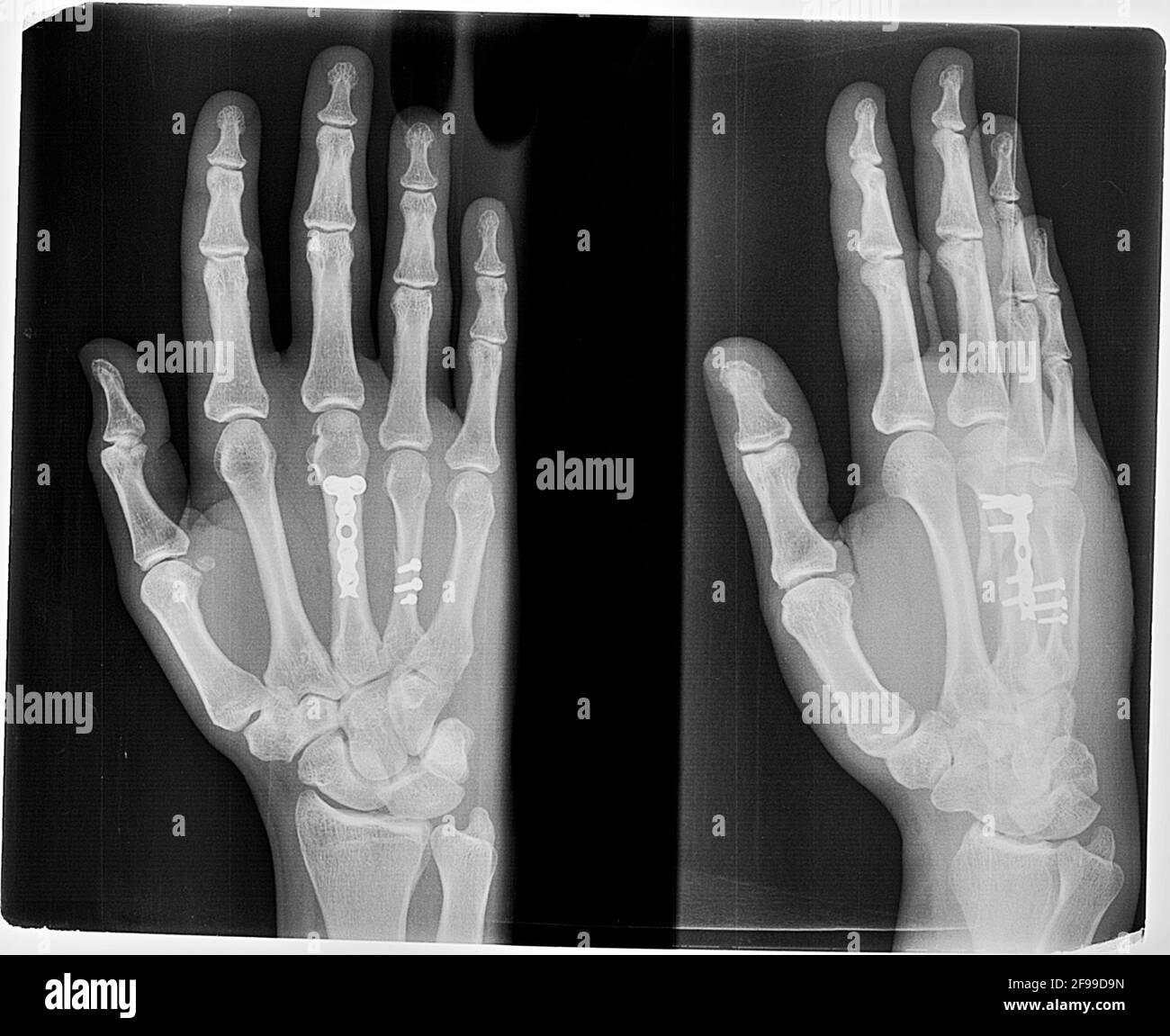 An x-ray showing a fracture of the 3rd and 4th metacarpal after open reduction surgery and internal fixation with a plate and screws Stock Photo