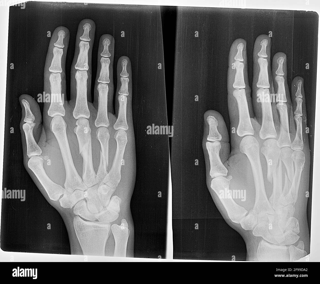 An x-ray showing a fracture of the 3rd and 4th metacarpal bones in the right hand Stock Photo
