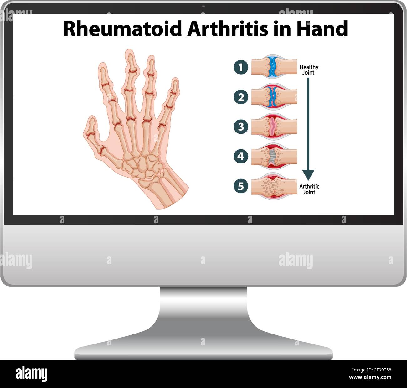 Rheumatoid arthritis symptoms on hand on computer desktop illustration Stock Vector Image & Art