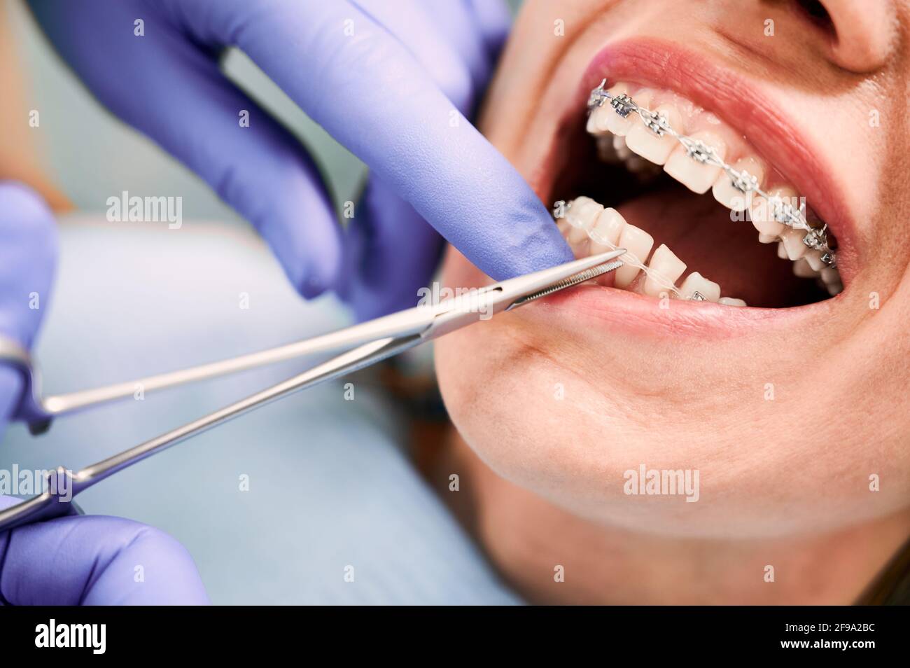 Close up of orthodontist hands in blue gloves using dental forceps