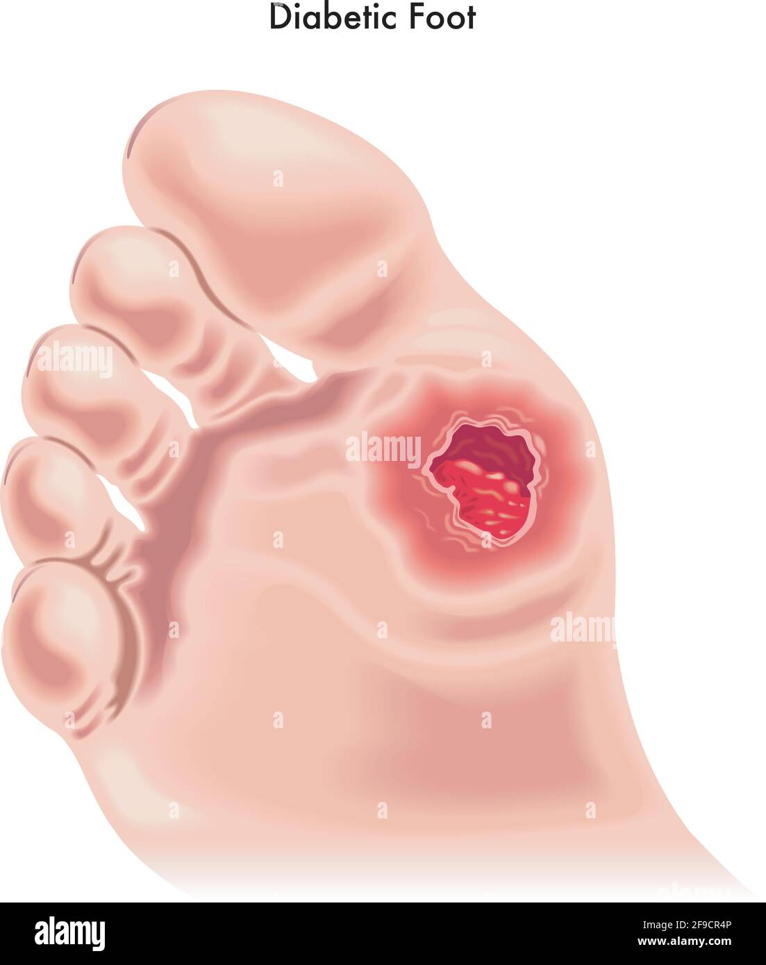 Medical illustration of the effects of the Diabetic foot. Stock Vector