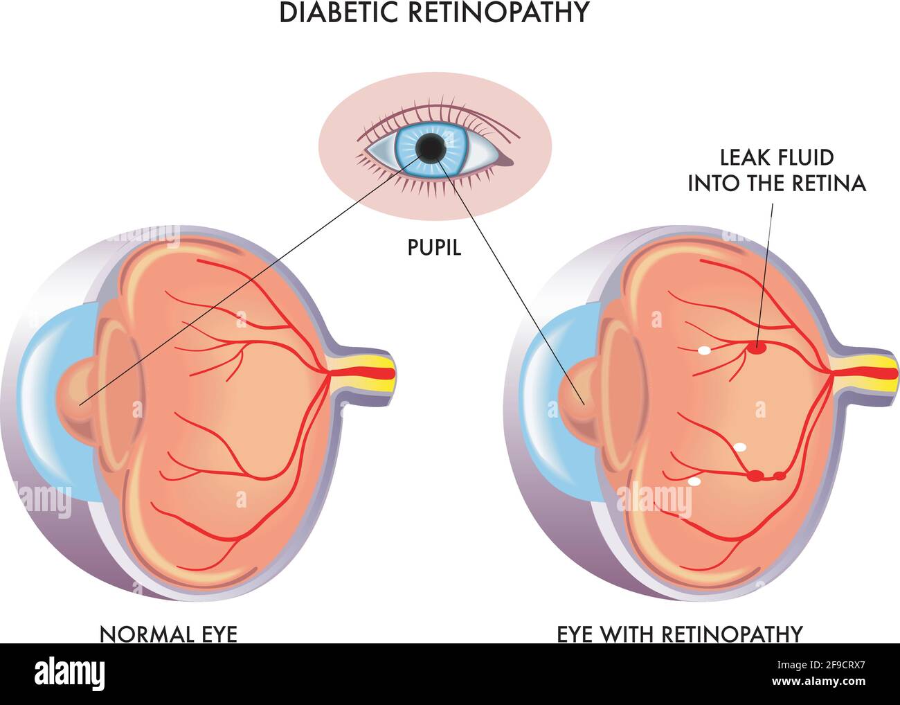 Medical illustration compares a normal eye to one with diabetic retinopathy, with annotations. Stock Vector