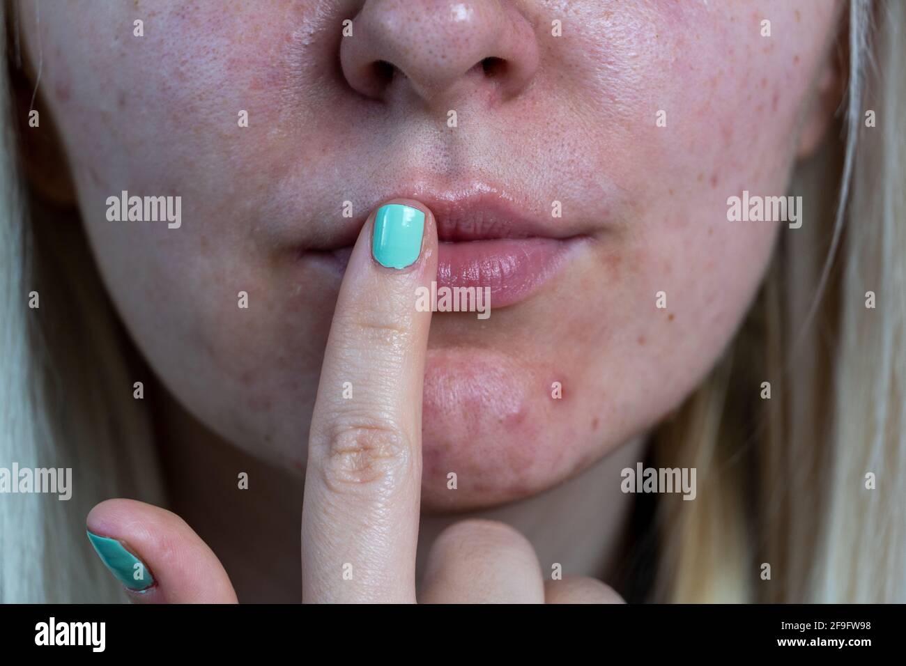 Part of a young woman's face with a virus herpes on lips, treatment with ointment. Young woman with cold sore applying cream onto lips Stock Photo