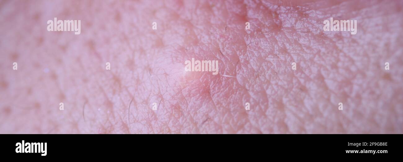 Inflammatory diseases of skin of face of teenager acne macro closeup Stock Photo