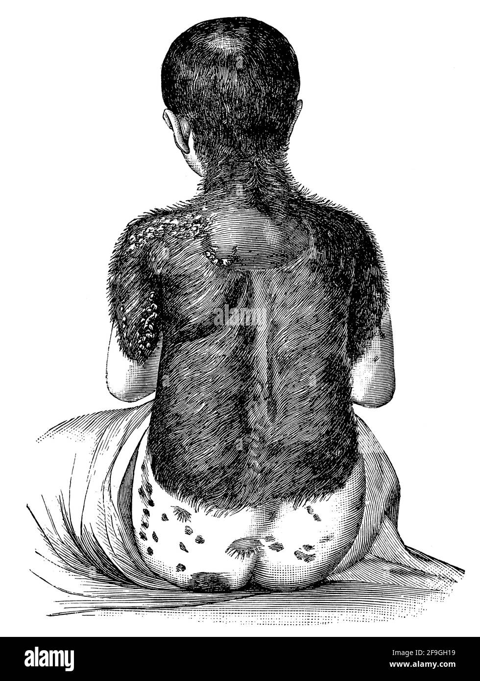 Rear view of a four year old partially hairy child. Hypertrichosis. Illustration of the 19th century. Germany. White background. Stock Photo