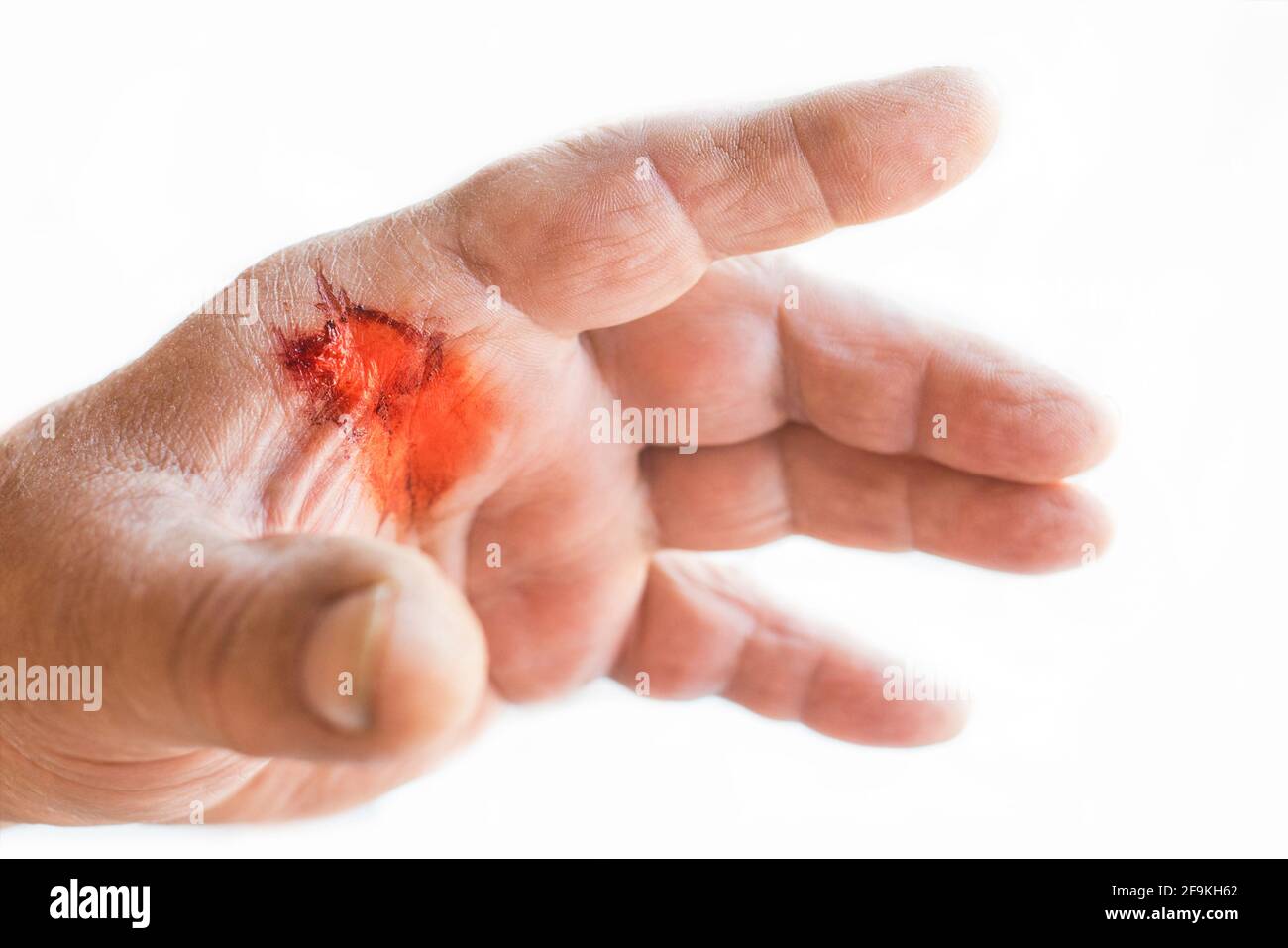 Man is putting the bandage on the wound. Bleeding injury. Deep cut with a  knife. Stock Photo