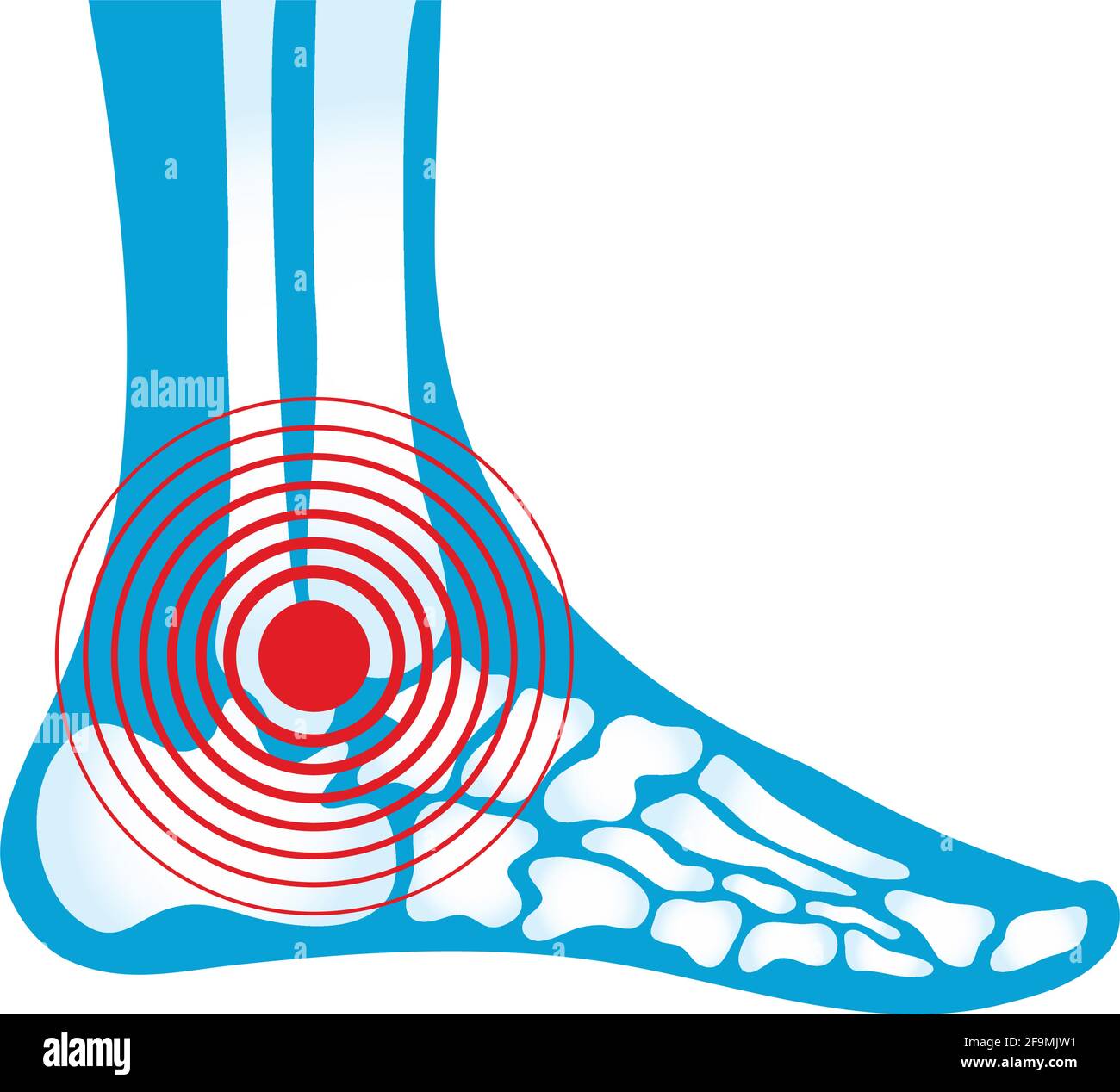 ankle rheumatological pain graphic icon Stock Vector Image & Art - Alamy