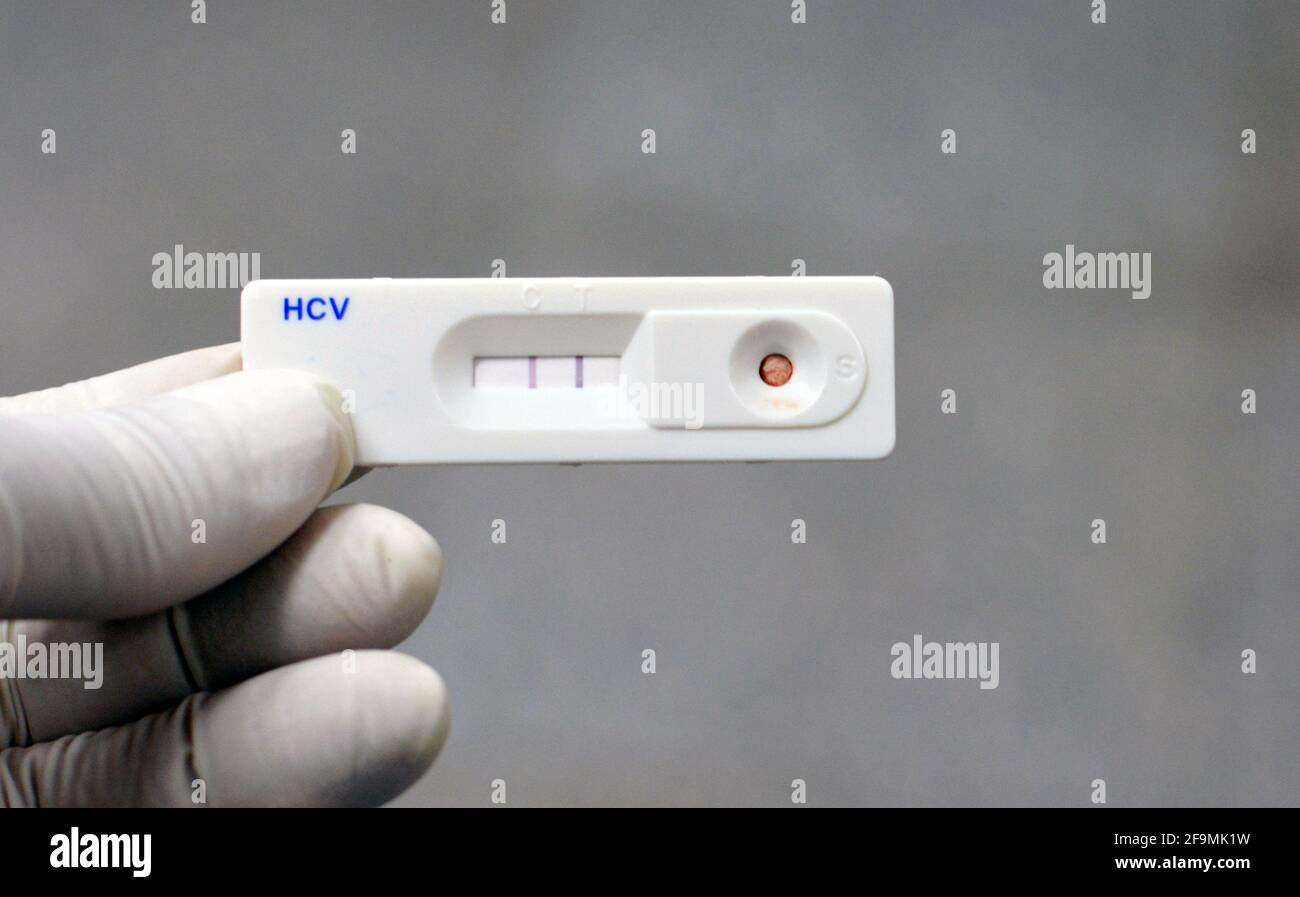 A positive result for Hepatitis C rapid test kit cassette that checks