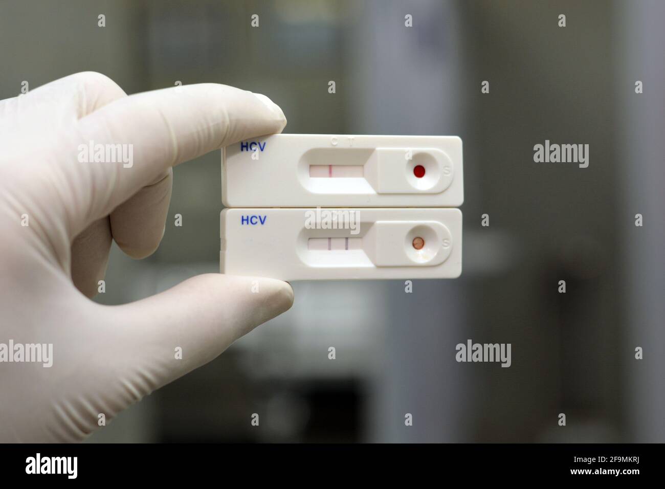Hepatitis jaundice liver virus hires stock photography and images Alamy
