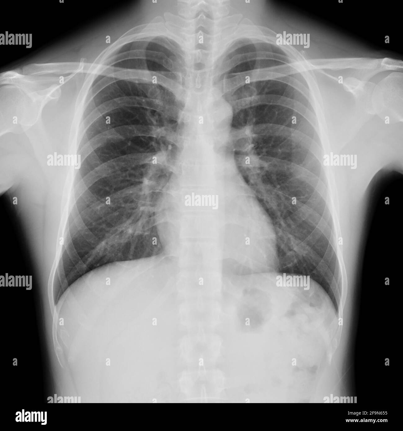 X ray chest normal not healthy Black and White Stock Photos & Images Alamy