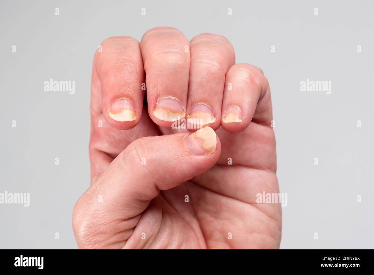 Onychomycosis or fungal nail infection on damaged nails after gel polish,  onychosis. Longitudinal ridging nails with psoriasis. Nail diseases, health  Stock Photo - Alamy