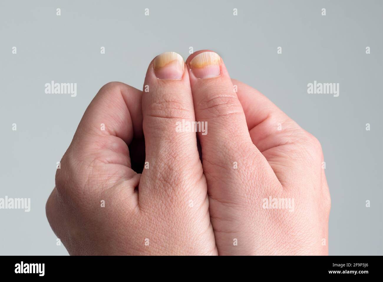 Onychomycosis or fungal nail infection on damaged nails after gel