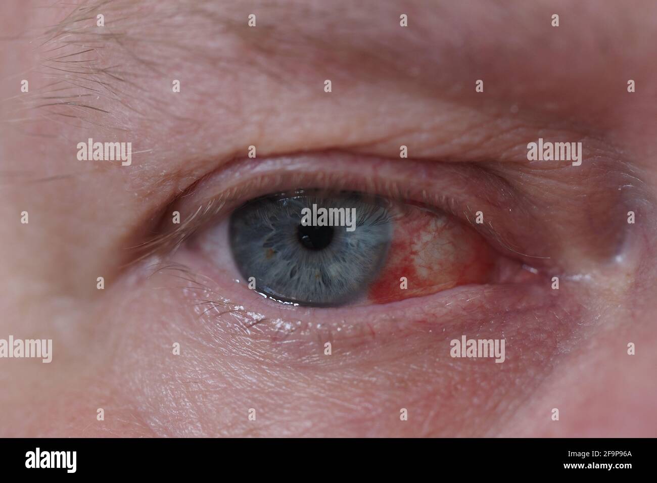 A man's eye. It's a macro- Eye disease, hemorrhage in the eye. Stock Photo