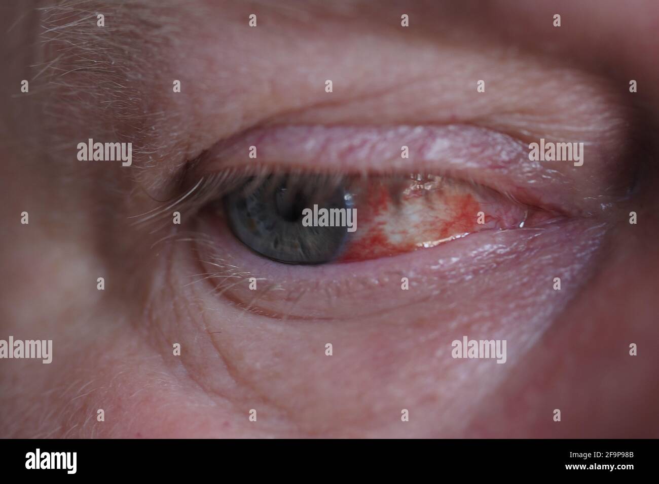 A man's eye. It's a macro- Eye disease, hemorrhage in the eye. Stock Photo