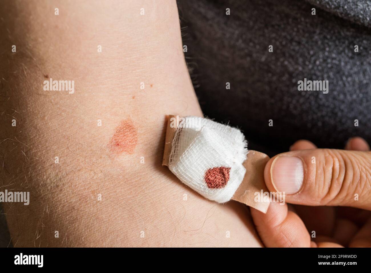 Puncture wound hires stock photography and images Alamy
