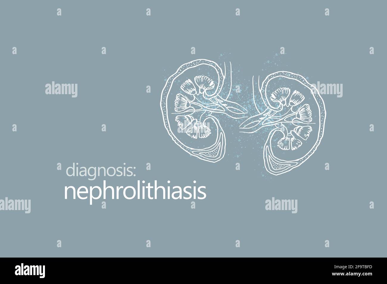 Nephrolithiasis kidney stones disease or urolithiasis. Renal Calculus or Stones blocking the urinary tract.Minimalistic style design template Stock Photo