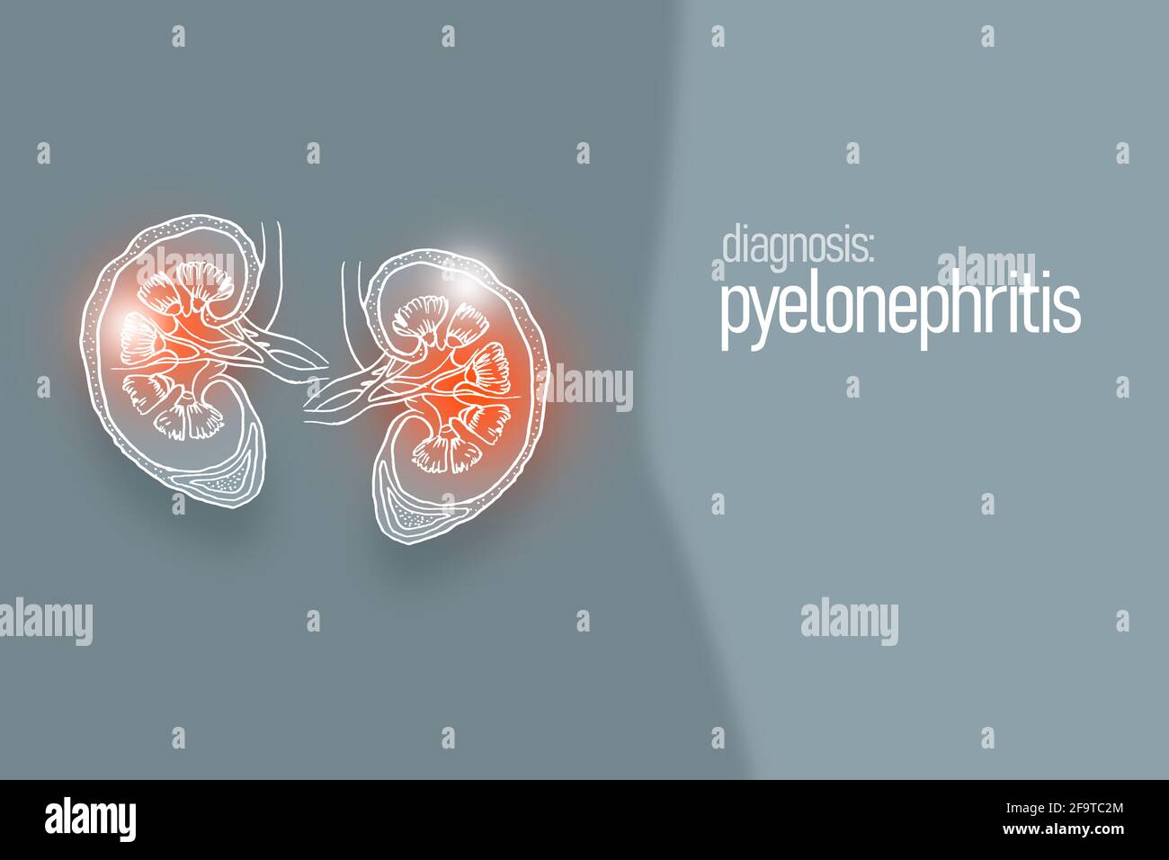 Pyelonephritis, aninflammation of the kidney, typically due to a ...