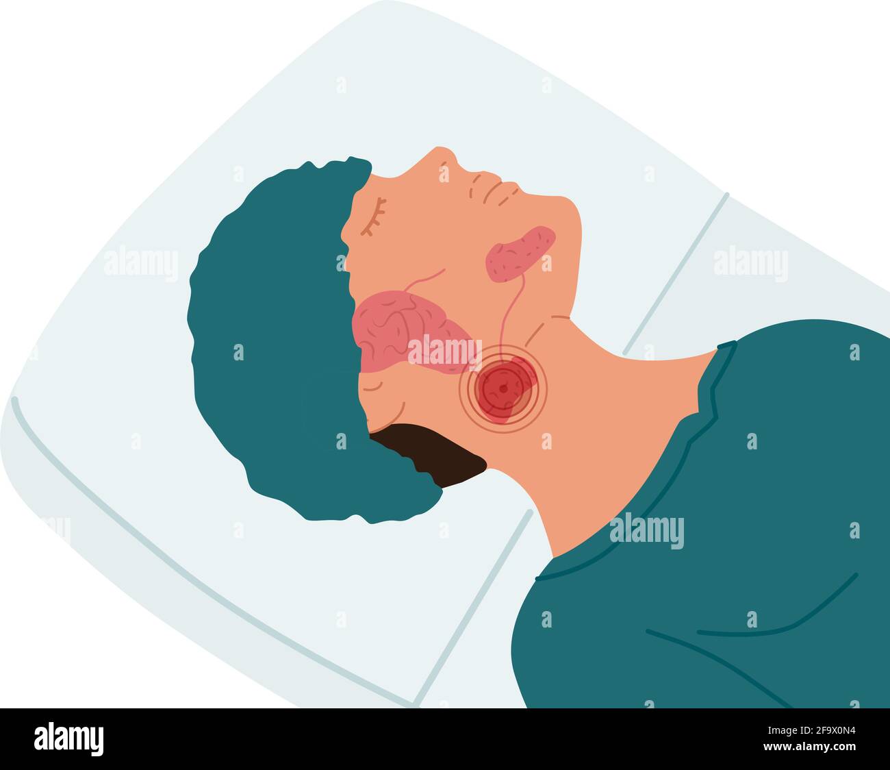 A patient with a diseased submandibular salivary gland. Vector illustration of sialolithiasis. Stock Vector