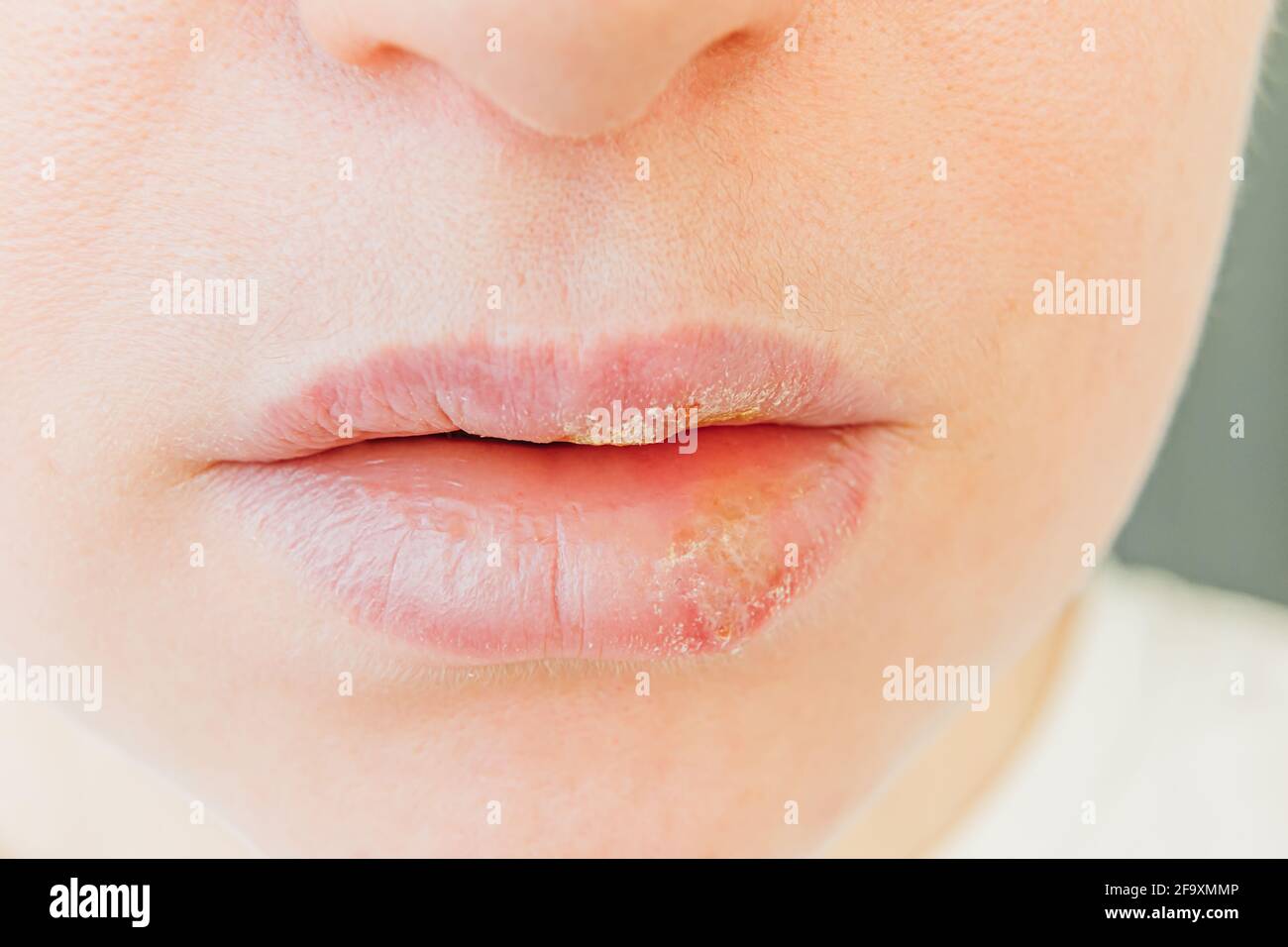 Close up of girl lips affected by herpes. Treatment of herpes infection