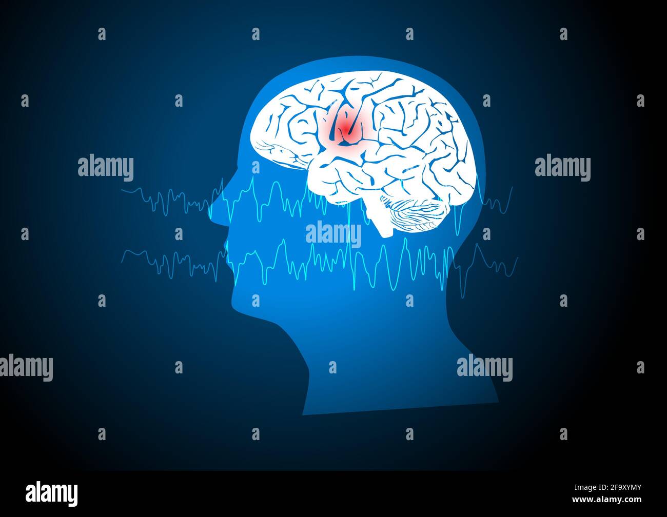 Focal seizure. Illustration of human brain and electroencephalograhy or EEG originating from one regional onset. Stock Vector