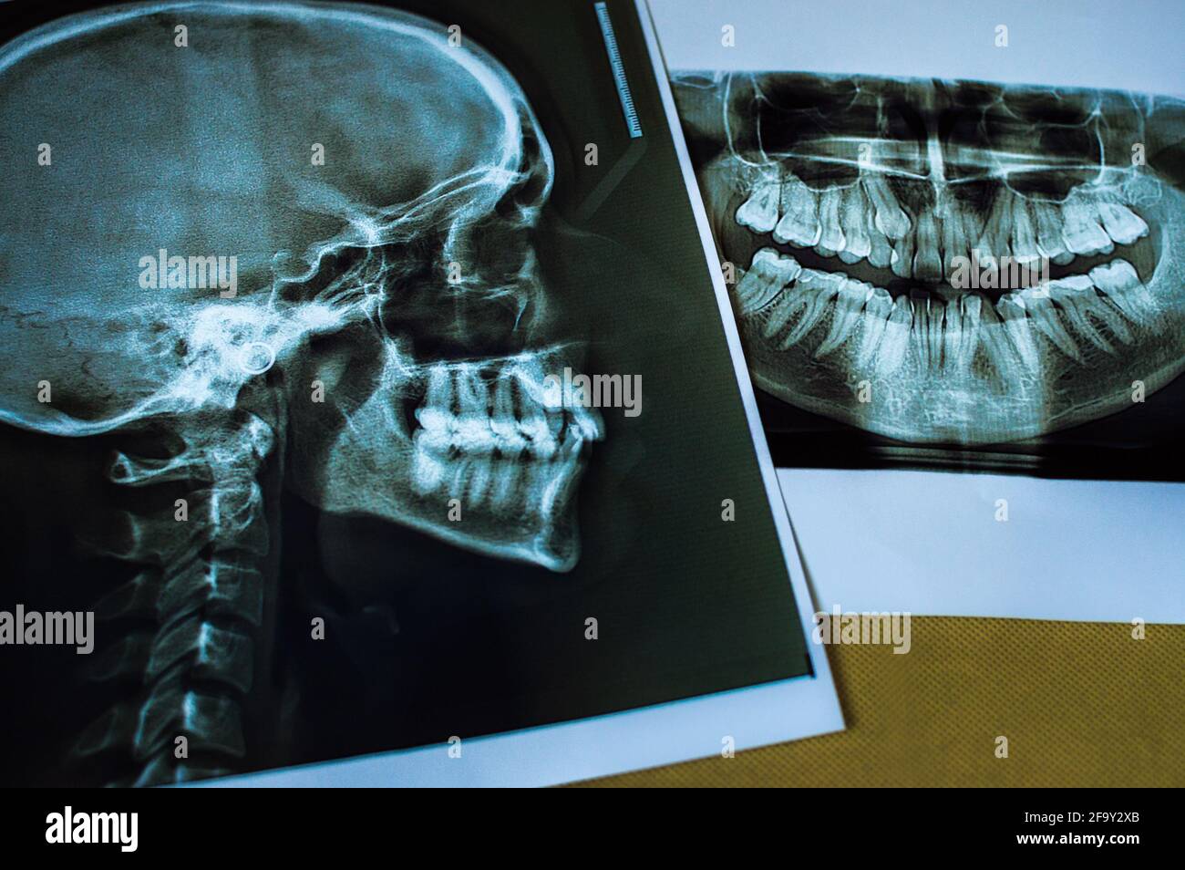 Xray of human skull in lateral projection and Panoramic dental XRay Stock Photo Alamy