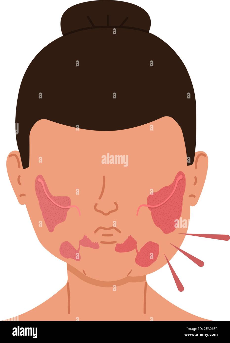 Woman with inflamed salivary glands. Medical vector illustration. Stock Vector