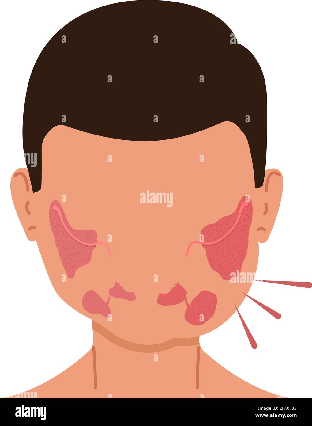 A person with inflamed salivary glands. Medical vector illustration. Stock Vector