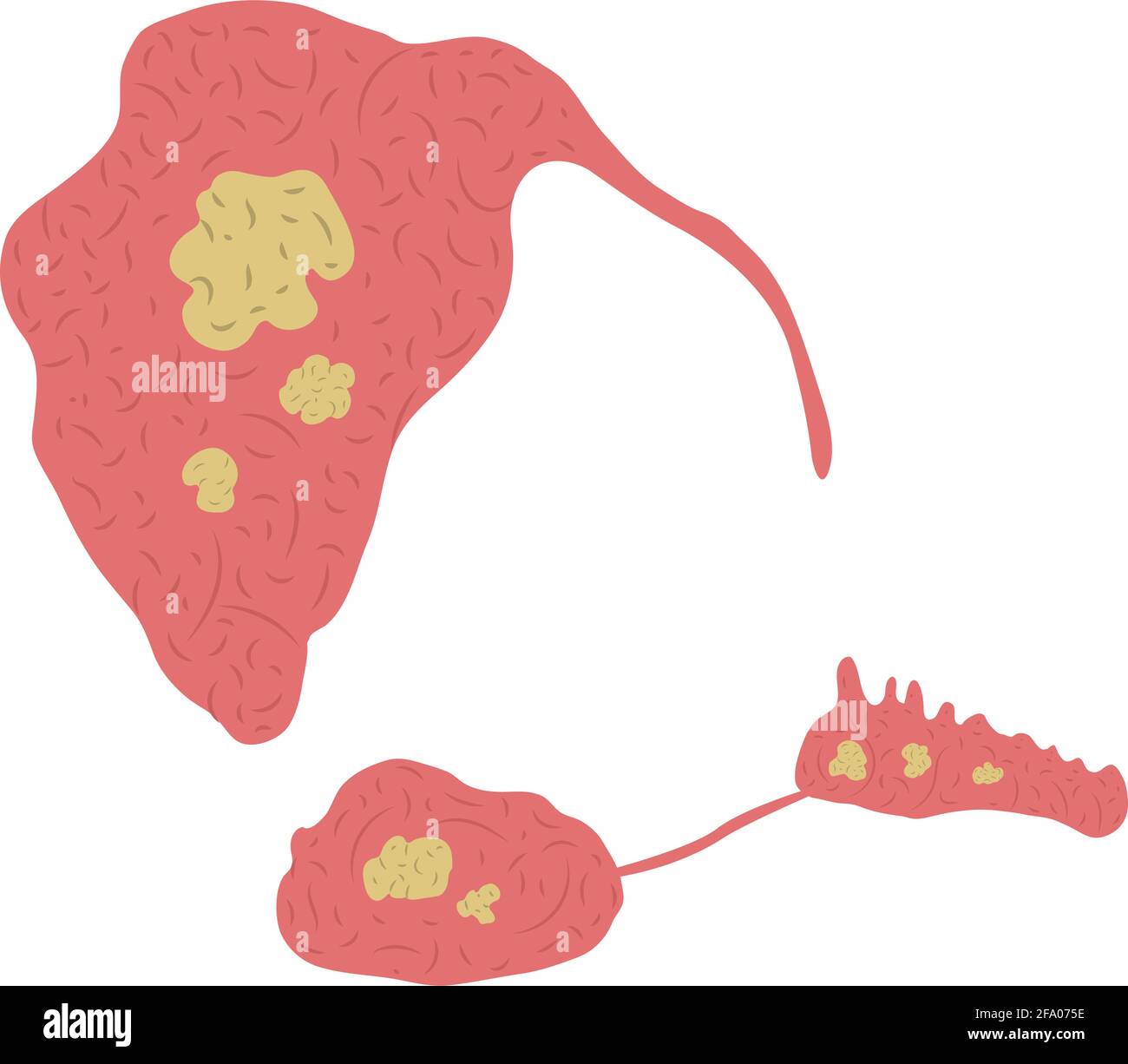 Vector illustration of stones in the salivary glands. Sialolithiasis Stock Vector