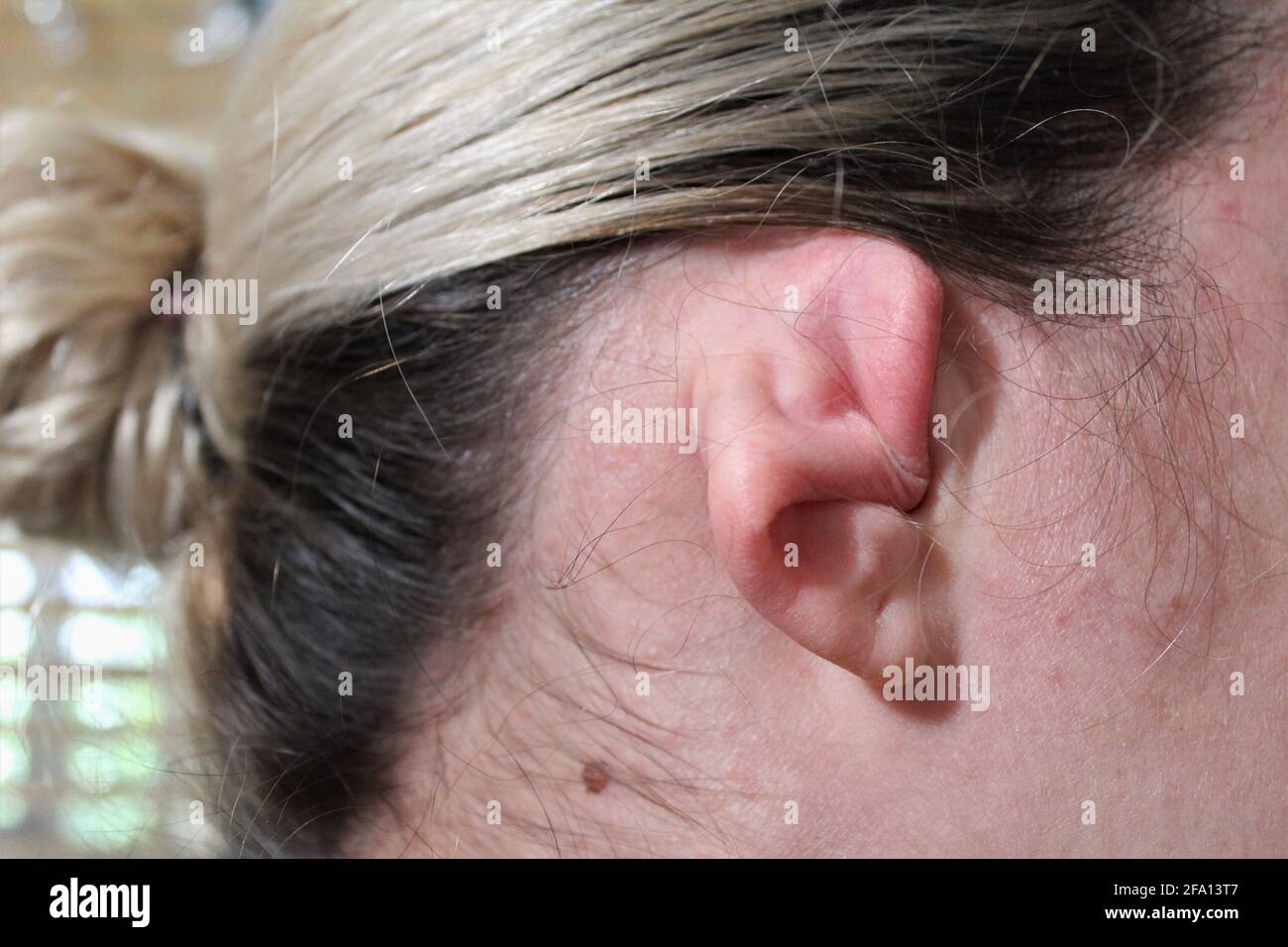 Cauliflower Ear High Resolution Stock Photography and Images - Alamy