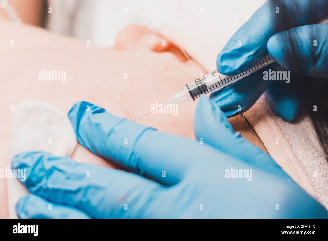 Miliums on the face, removal of hardened and mature milia by a beautician. new Stock Photo