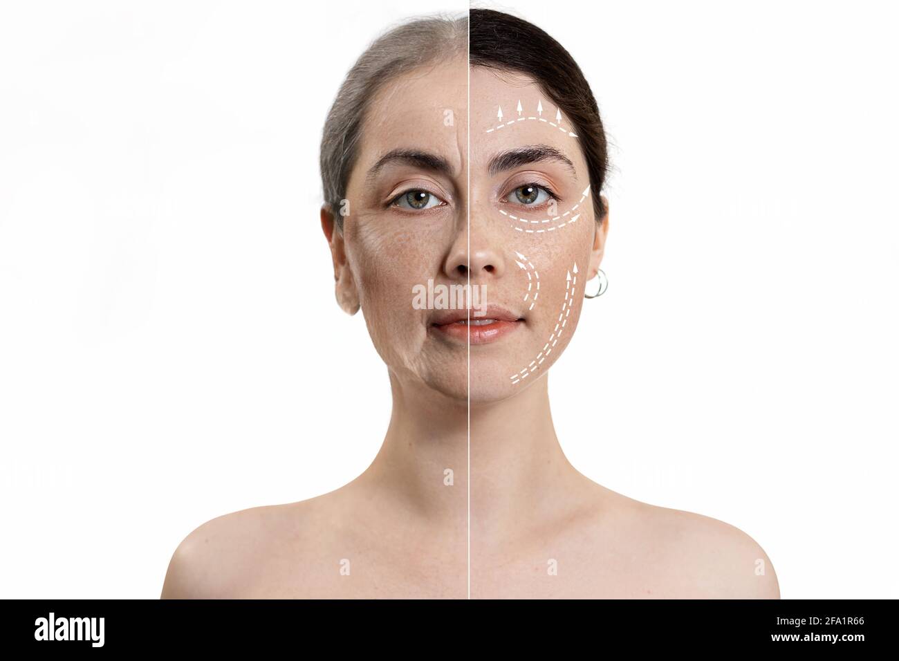 Result Before And After Cosmetic Procedures Portrait Of A Woman