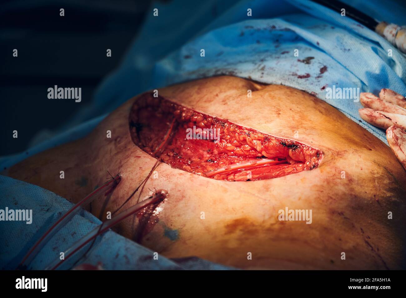 Close up of open wound during tummy tuck surgery in clinic. Medical