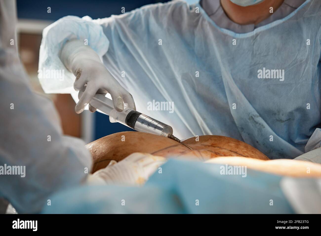 cosmetic liposuction surgery in actual operating room setting showing