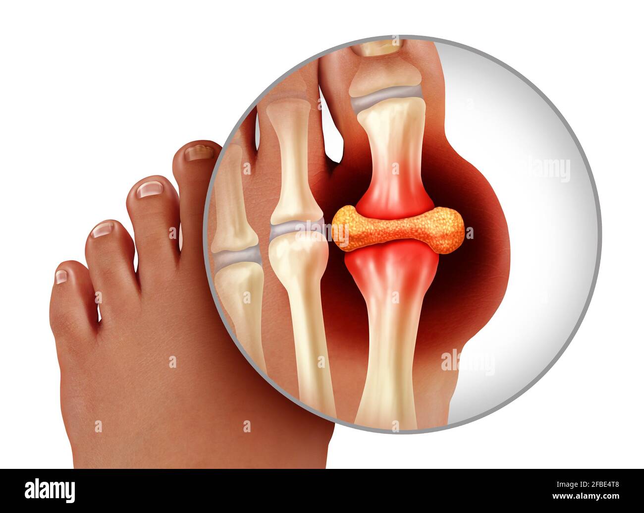 Foot gout and painful feet arthritis disease as toes close up with a human toe as a hyperuricemia symbol of treating and diagnosing chronic pain. Stock Photo