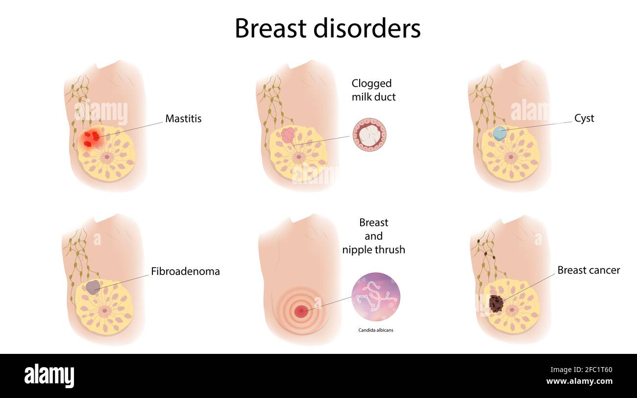 Female breast disorders, illustration Stock Photo