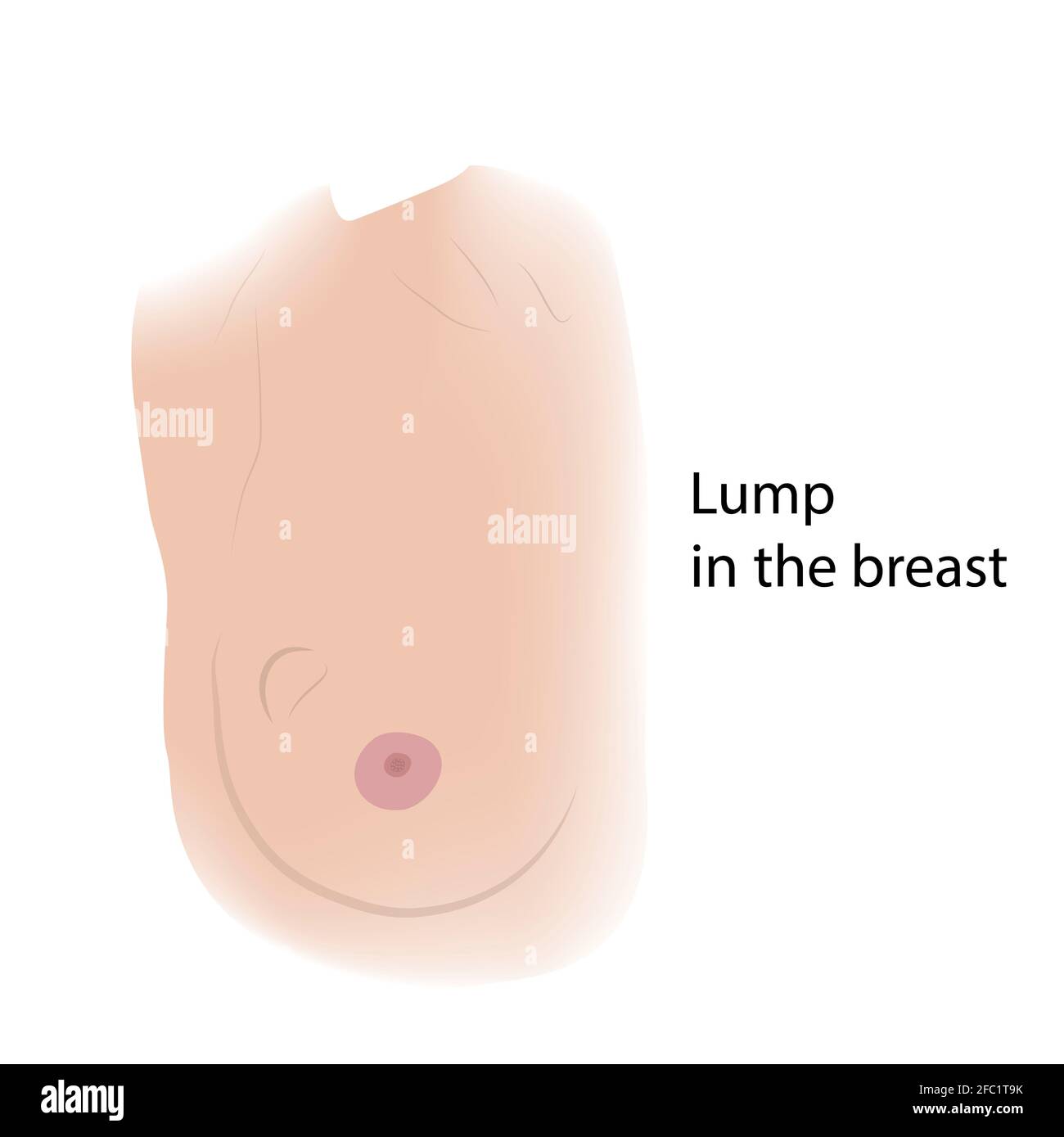 Breast lump, illustration Stock Photo