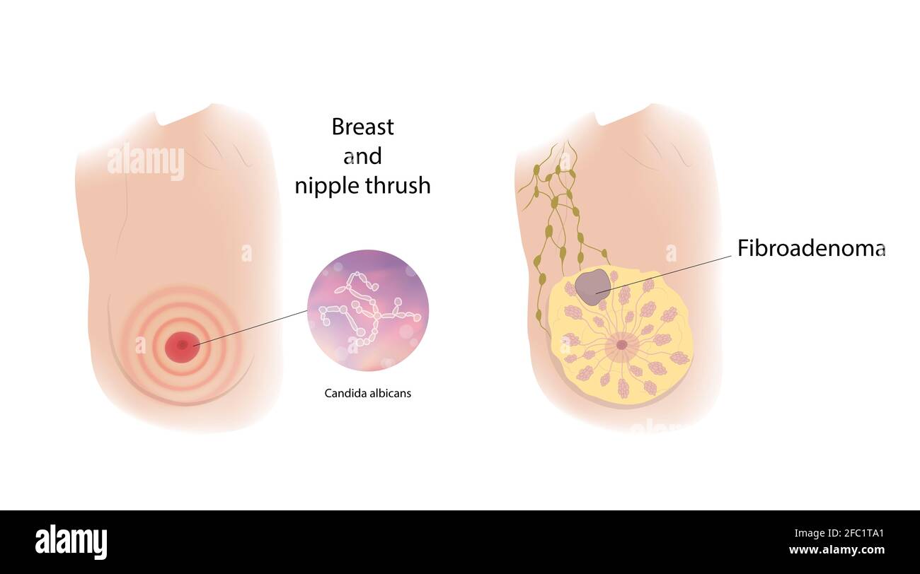 Fibroadenoma and breast thrush, illustration Stock Photo