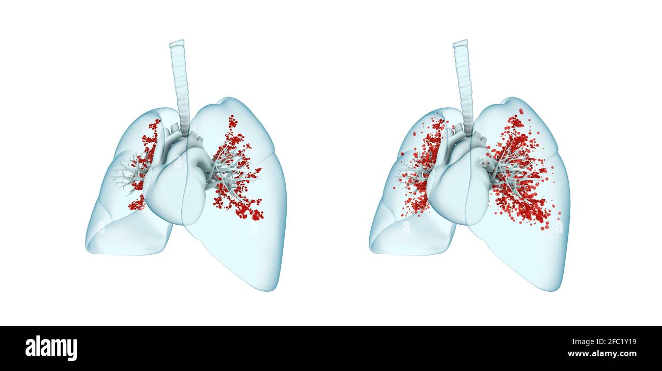 Viral lung infection, illustration Stock Photo Alamy