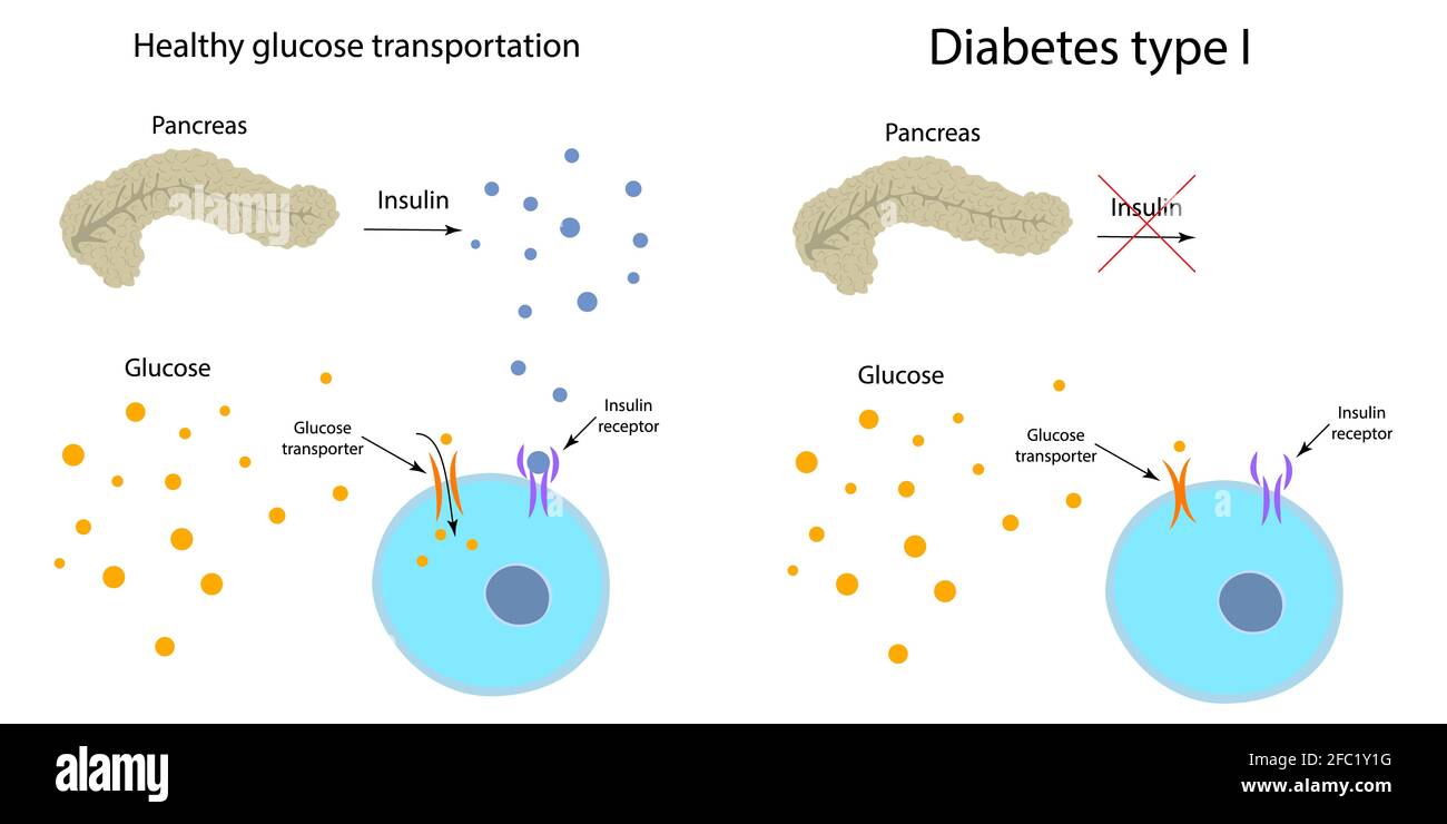 Diabetes type 1 and healthy glucose metabolism, illustration Stock Photo -  Alamy