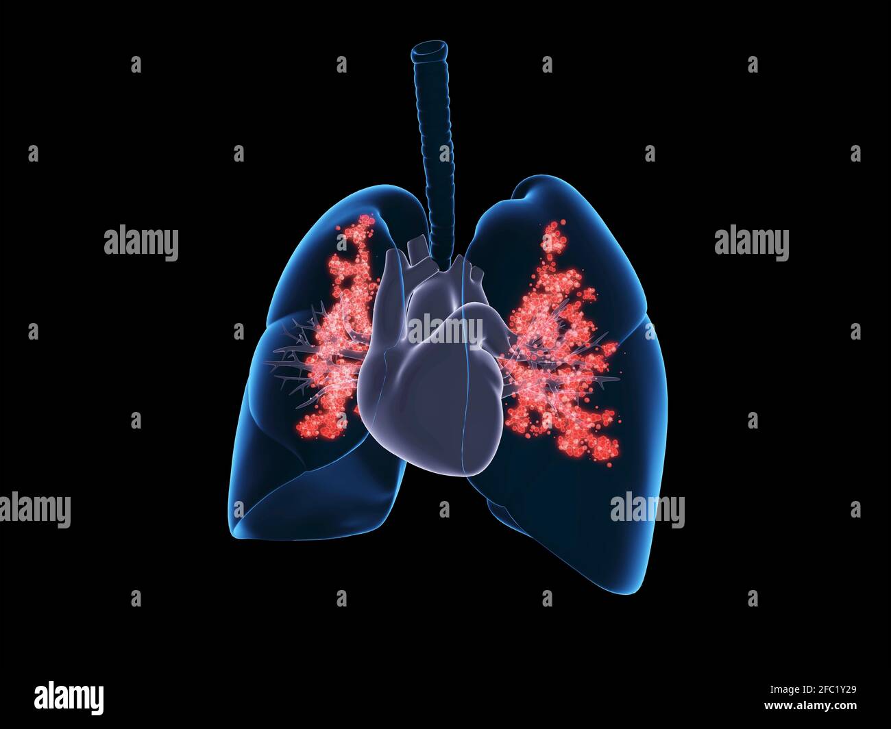 Viral lung infection, illustration Stock Photo