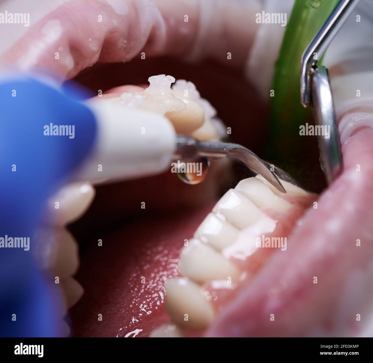 Close up of orthodontist using dental tools while cleaning teeth of