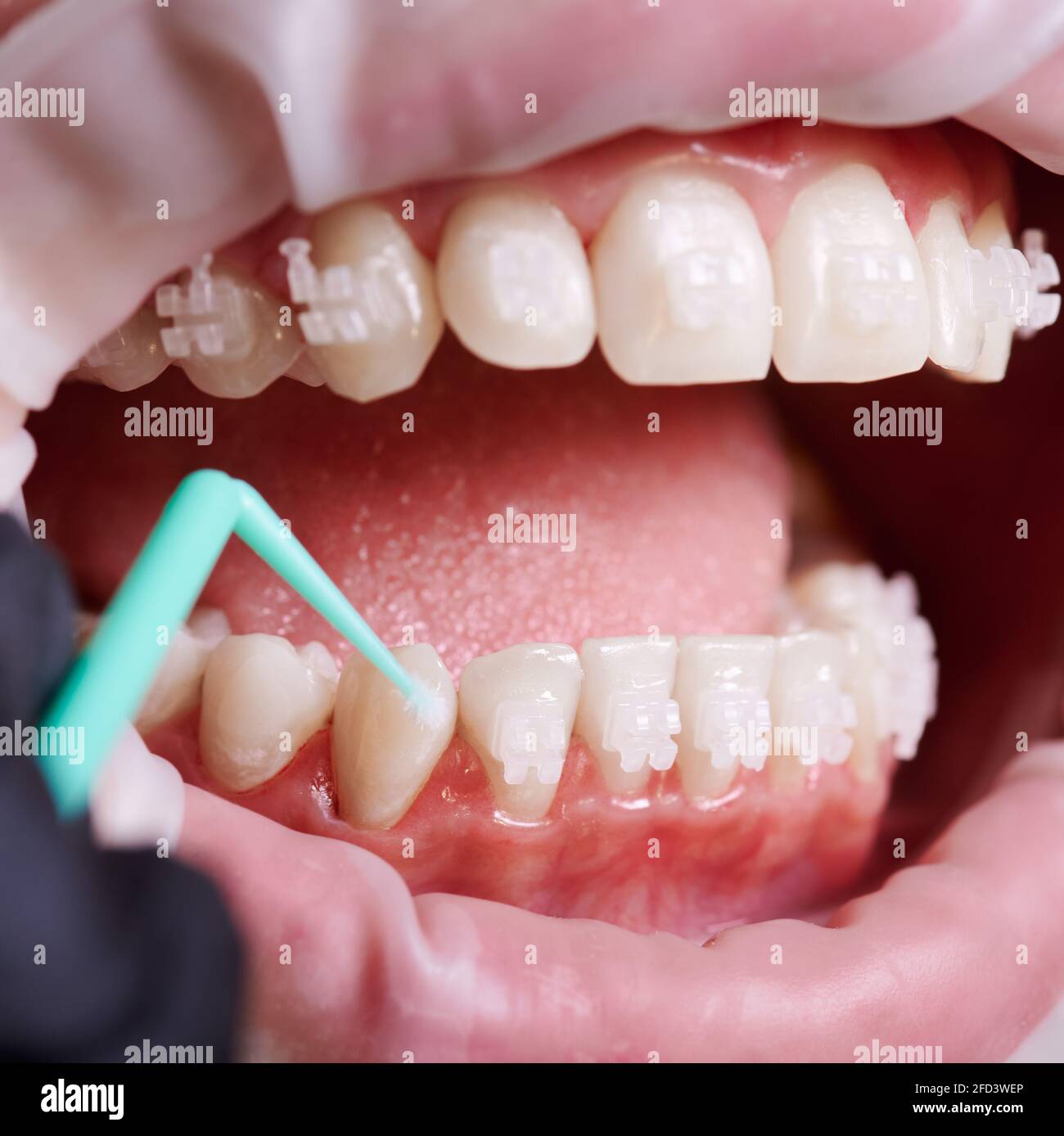 Macro shot of dentist's hand, brushing lower teeth with tiny green brush, before attaching next