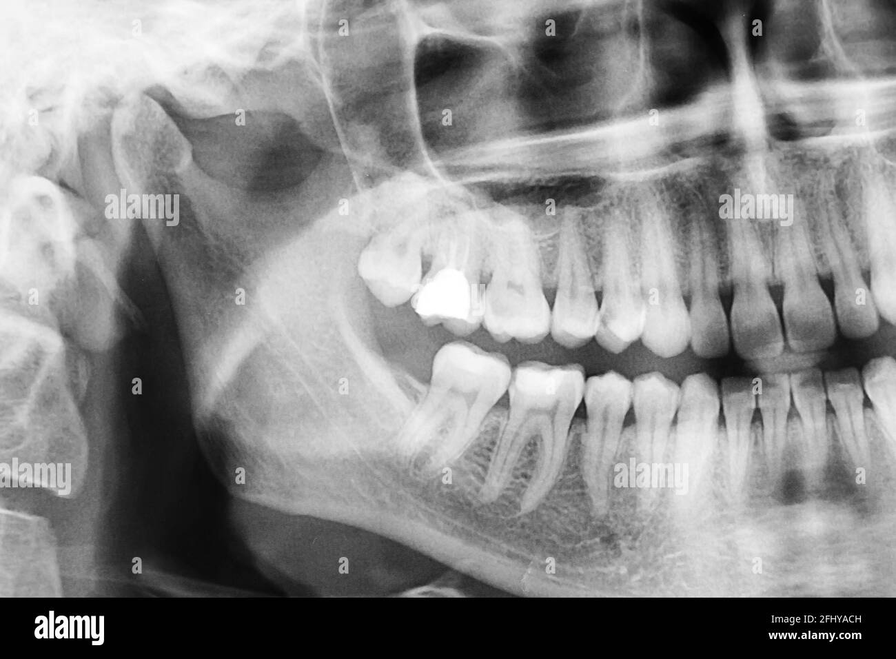 Panoramic dental x-ray of the oral cavity with teeth Stock Photo