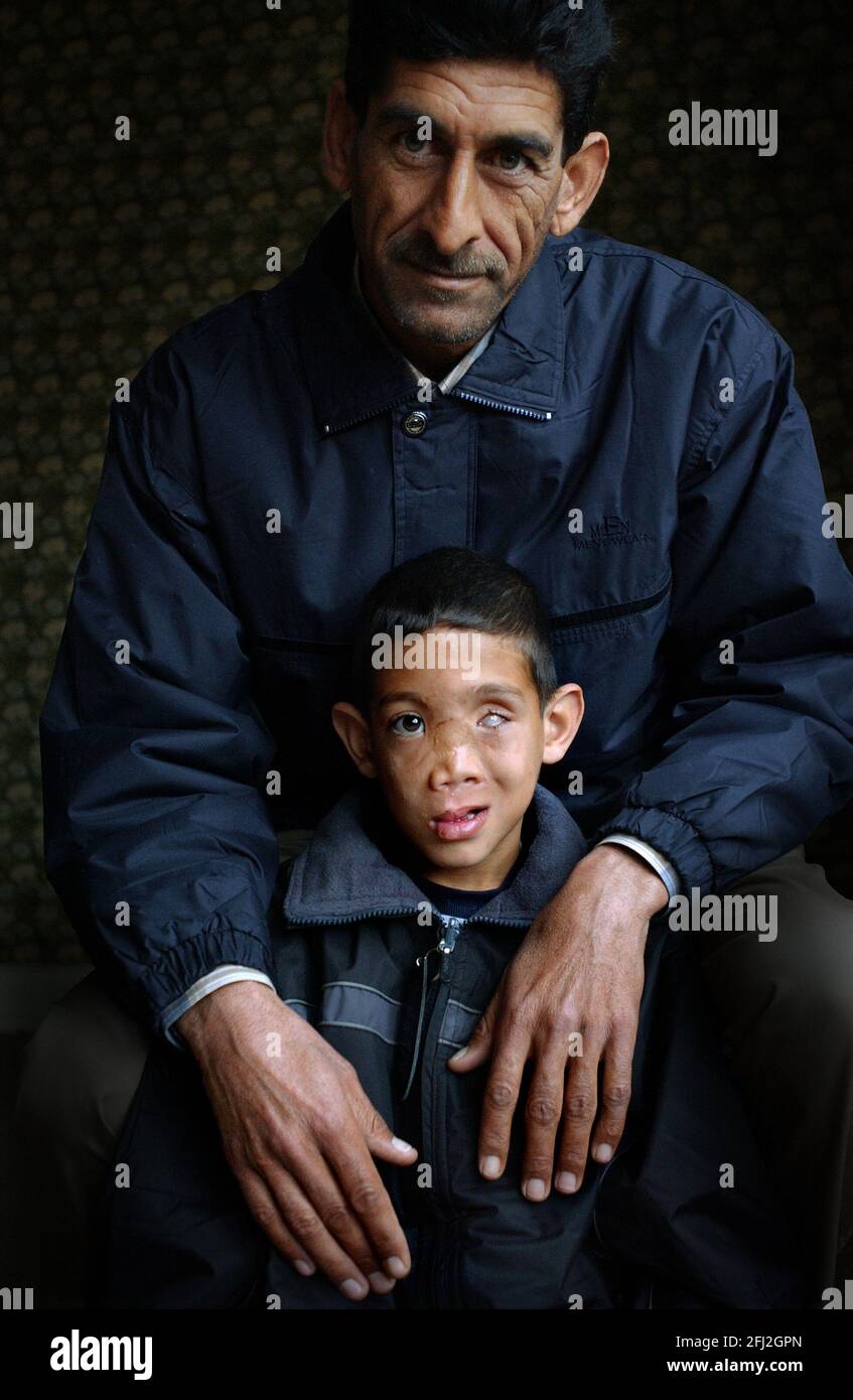 ALI HUSSEIN WITH HIS FATHER HUSSEIN MOHAMMAD JALOUB. ALI ,FROM IRAQ,WAS BADLY HURT DURING THE WAR AND IS IN THE UK FOR FACE RECONSTRUCTION. 10/3/04 PILSTON Stock Photo