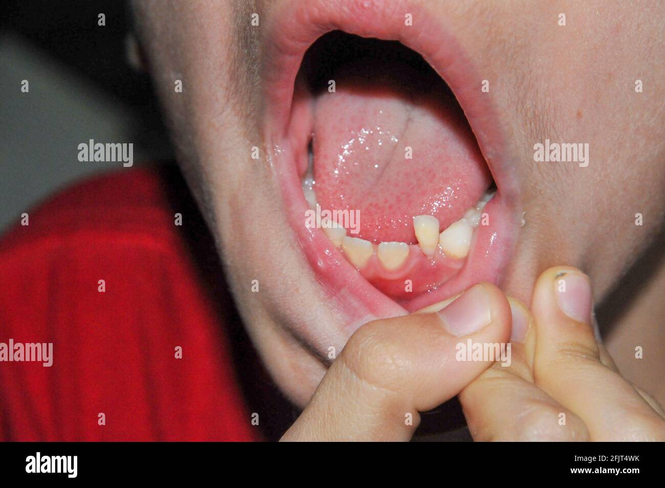 Young boy of six with a loose bottom tooth and missing two front teeth Stock Photo