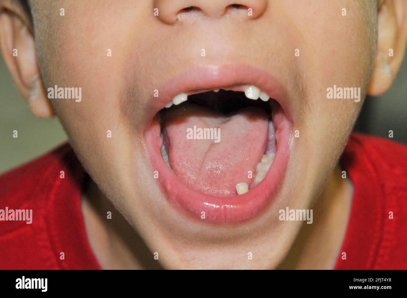 Young boy of six with a loose bottom tooth and missing two front teeth Stock Photo