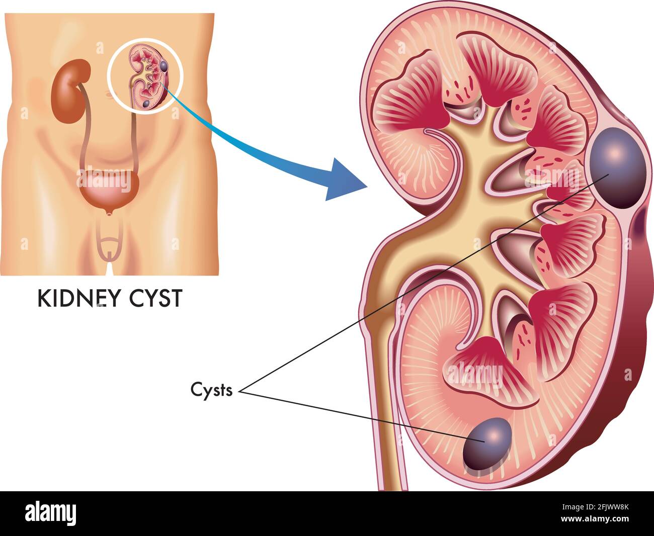 Medical illustration of a kidney with some cysts. Stock Vector