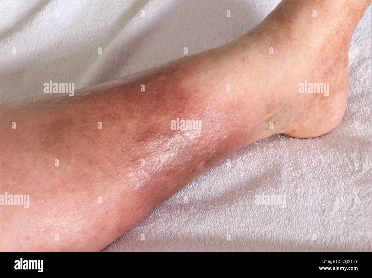 Woman's leg She's suffering from Chronic Venous Insufficiency with mild cellulitis. In bed as she rest to relieve heaviness swelling pain  redness leg Stock Photo